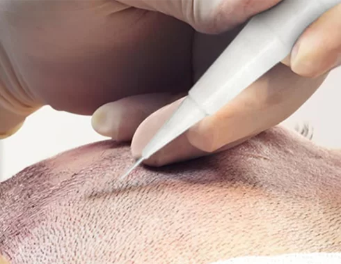 DHI-Haartransplantation
