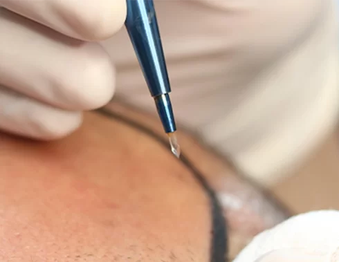 Sapphire FUE-Haartransplantation