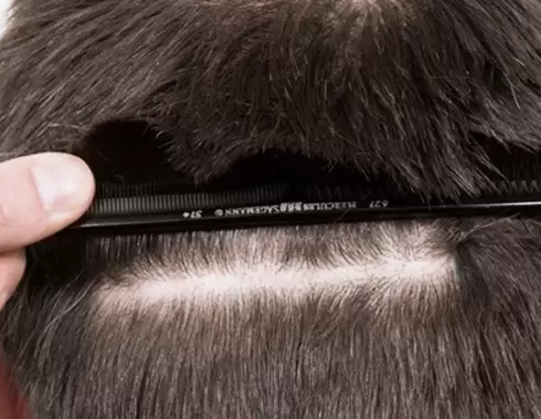 FUE-Haartransplantation