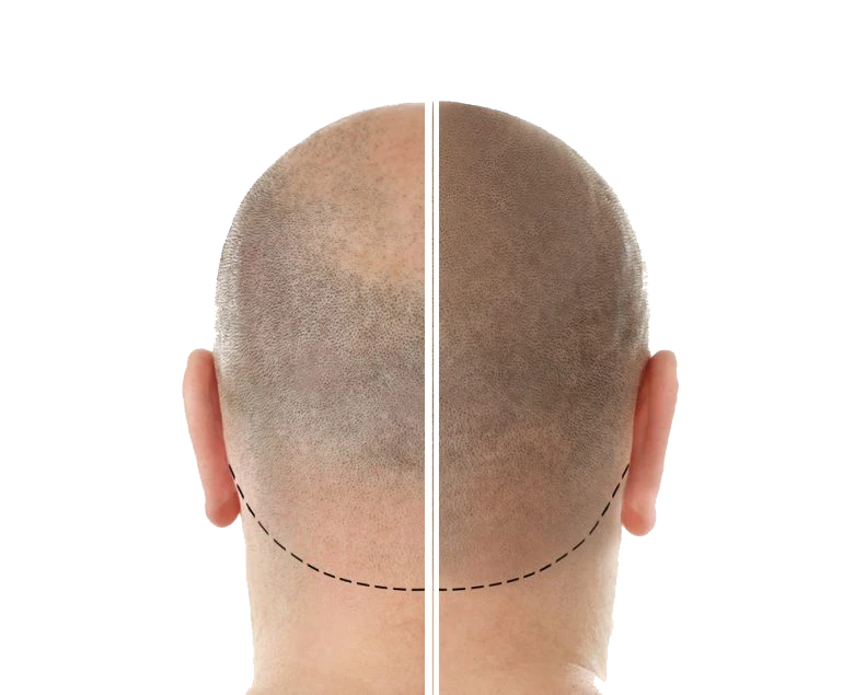 B.D Haartransplantation